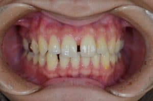 En närbild på tänder som har ett glapp mellan framtänderna