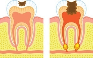 Illustration på tänder med infektion