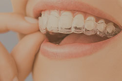 Närbild på en mun med invisalign osynlig tandställning