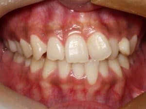 En närbild på snea tänder som behöver behandling