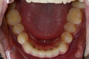 En närbild på tänder i underkäken som är raka