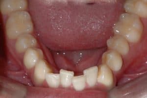En närbild på tänder i underkäken som är snea