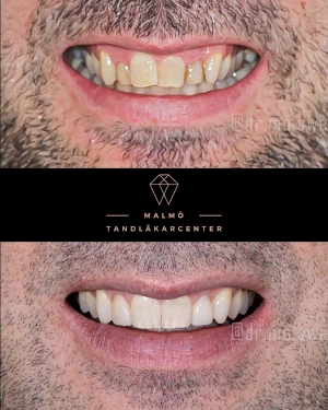 Person som ler med snea tänder och en bild på samma person som ler med raka tänder efter invisalign behandling