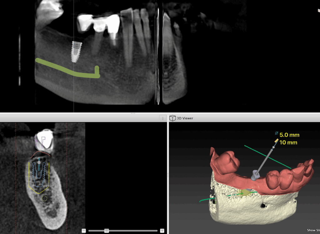 Tandimplantat 3D planering