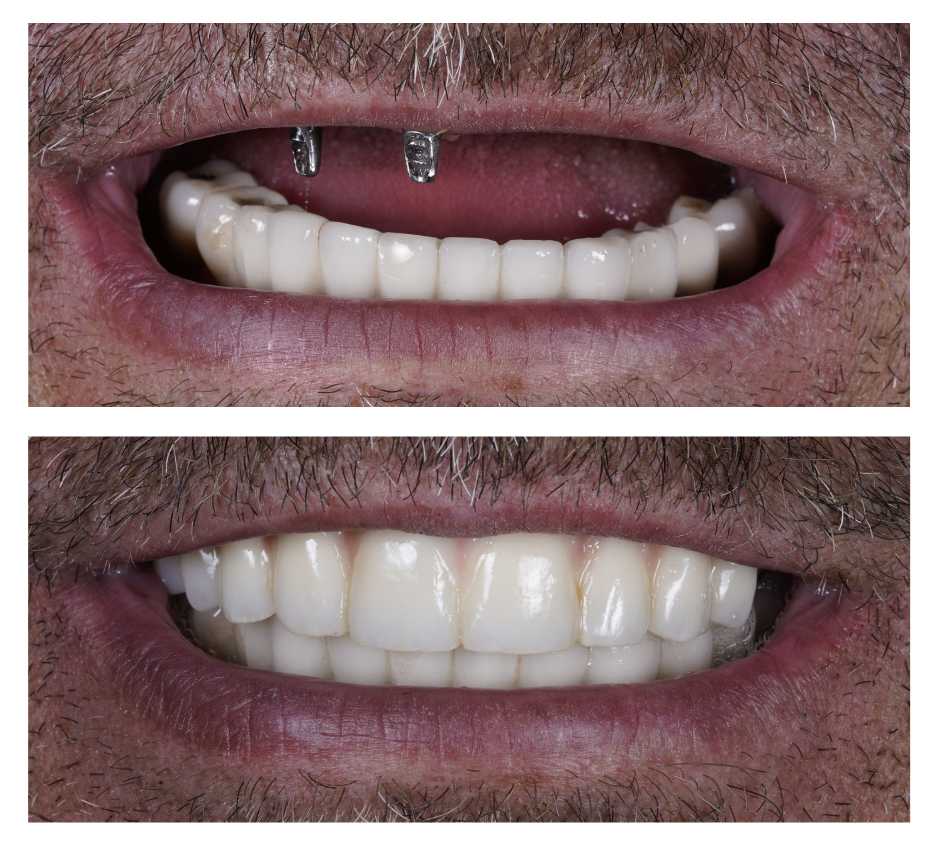 Implantat 2